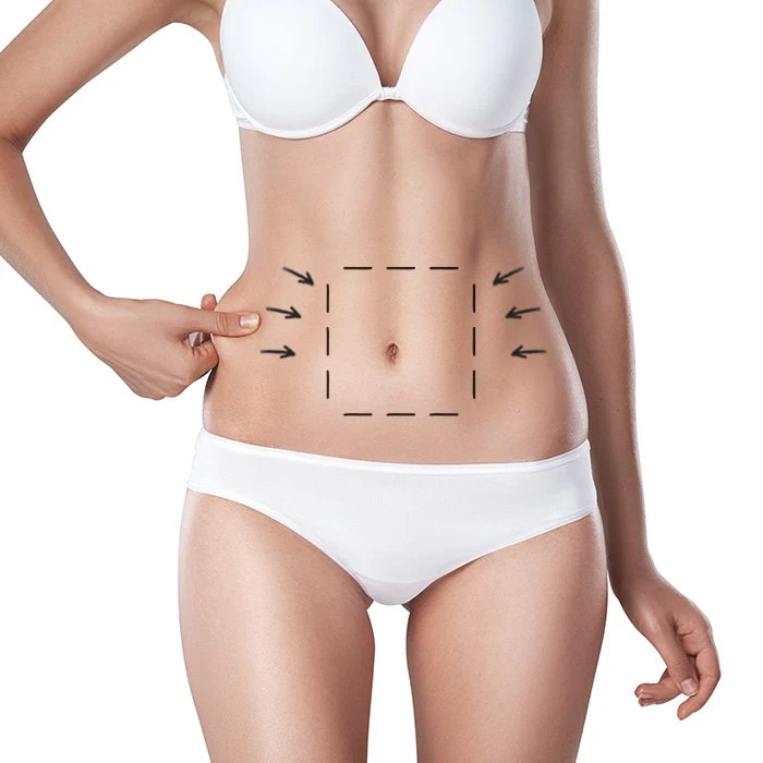Abdominoplastia