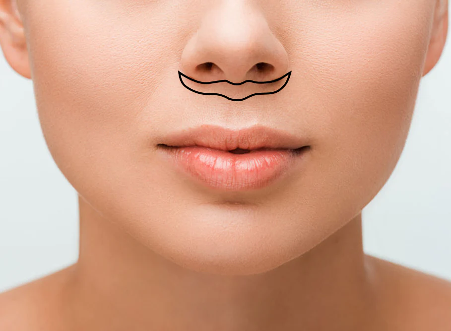 Lip Lift
